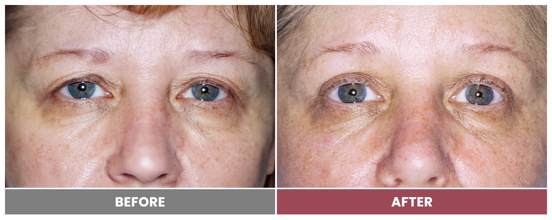 Upper Blepharoplasty - Case 24